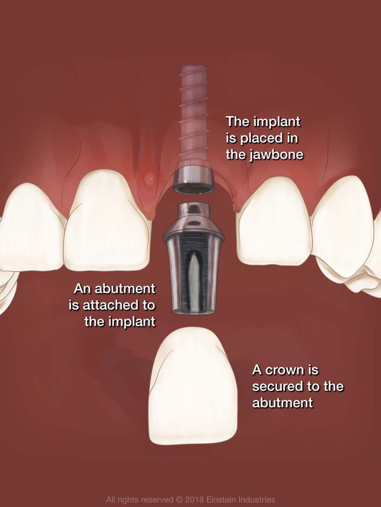 Illustration of jaw and dental implant
