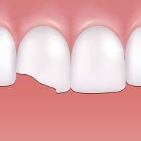 Chipped teeth