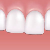 Misaligned teeth