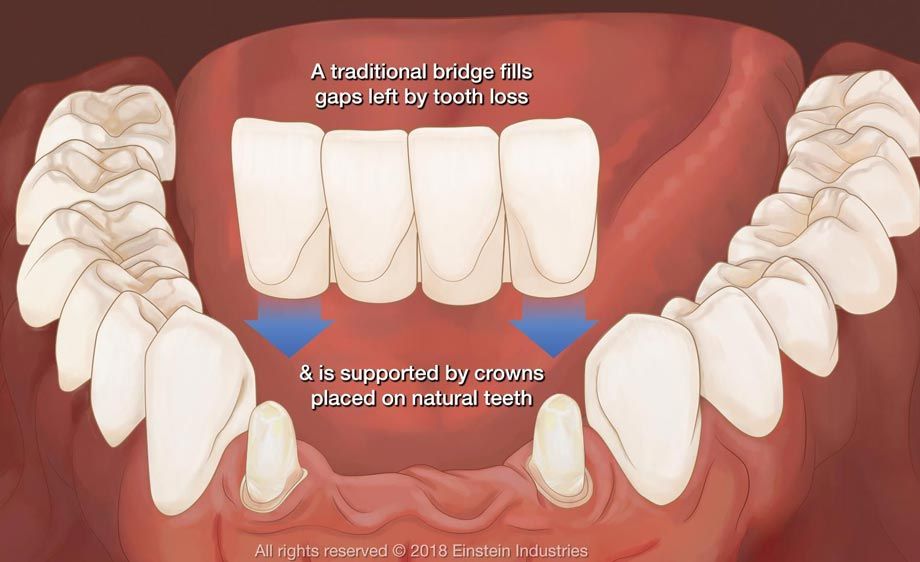 An illustration of a traditional dental bridge being placed